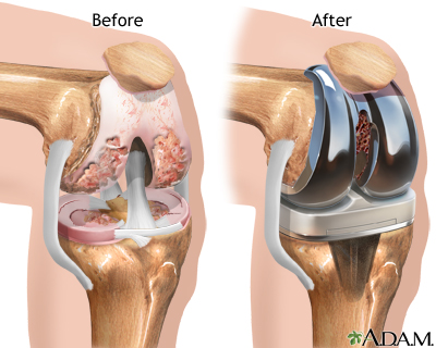 Guest Blog- Busting Myths on Total Knee Arthroplasty
