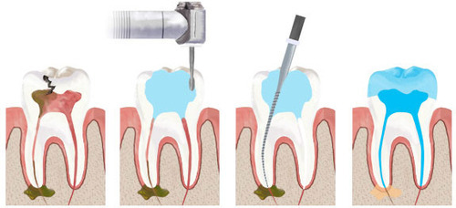 Guest Blog: Myths About Root Canal Treatment