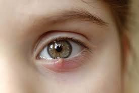 eye-problems-remedies