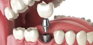 Guest Blog- Know All About Dental Implants