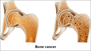 bone-cancer-detection