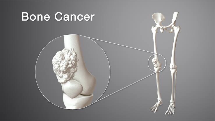 Guest Blog- Early Detection of Bone Cancer Can Prevent Limb Amputation