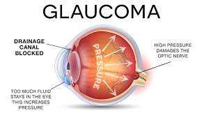 glaucoma-myths