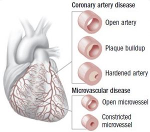 heart-diseases-in-women