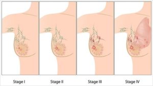 breast-cancer-symptoms