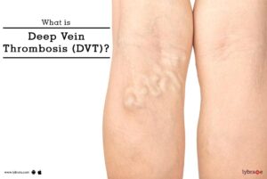 Deep-Vein-Thrombosis-causes