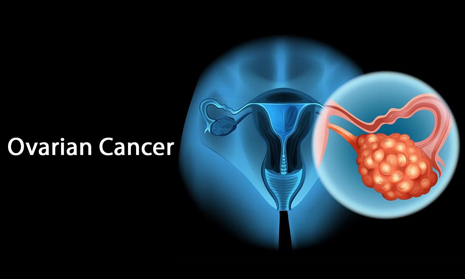 Advances In Ovarian Cancer Treatment Can Save Indian Women
