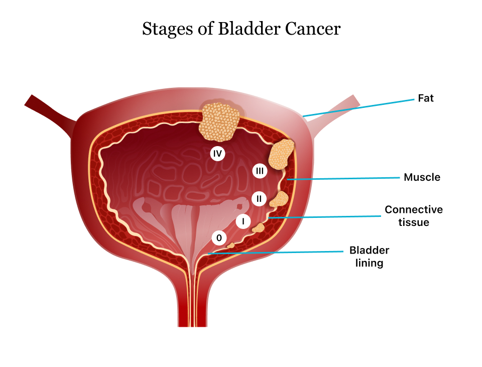 Guest Blog: All You Need To Know About Bladder Cancer