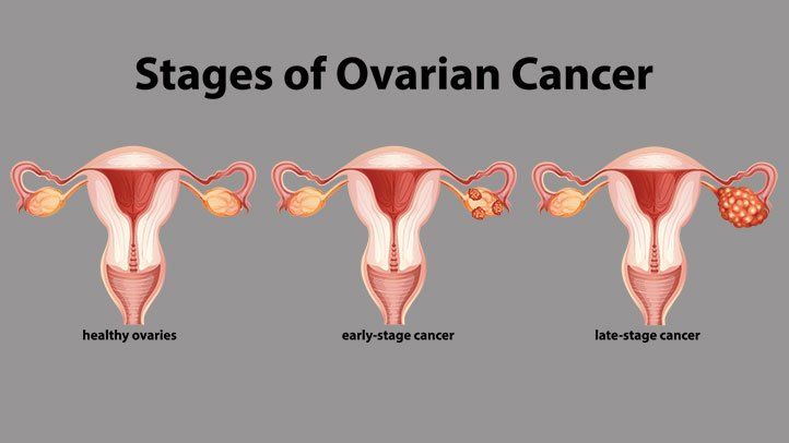Guest Blog- Advances In Ovarian Cancer Treatment Can Save Many Women In India