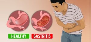 gastritis-remedies