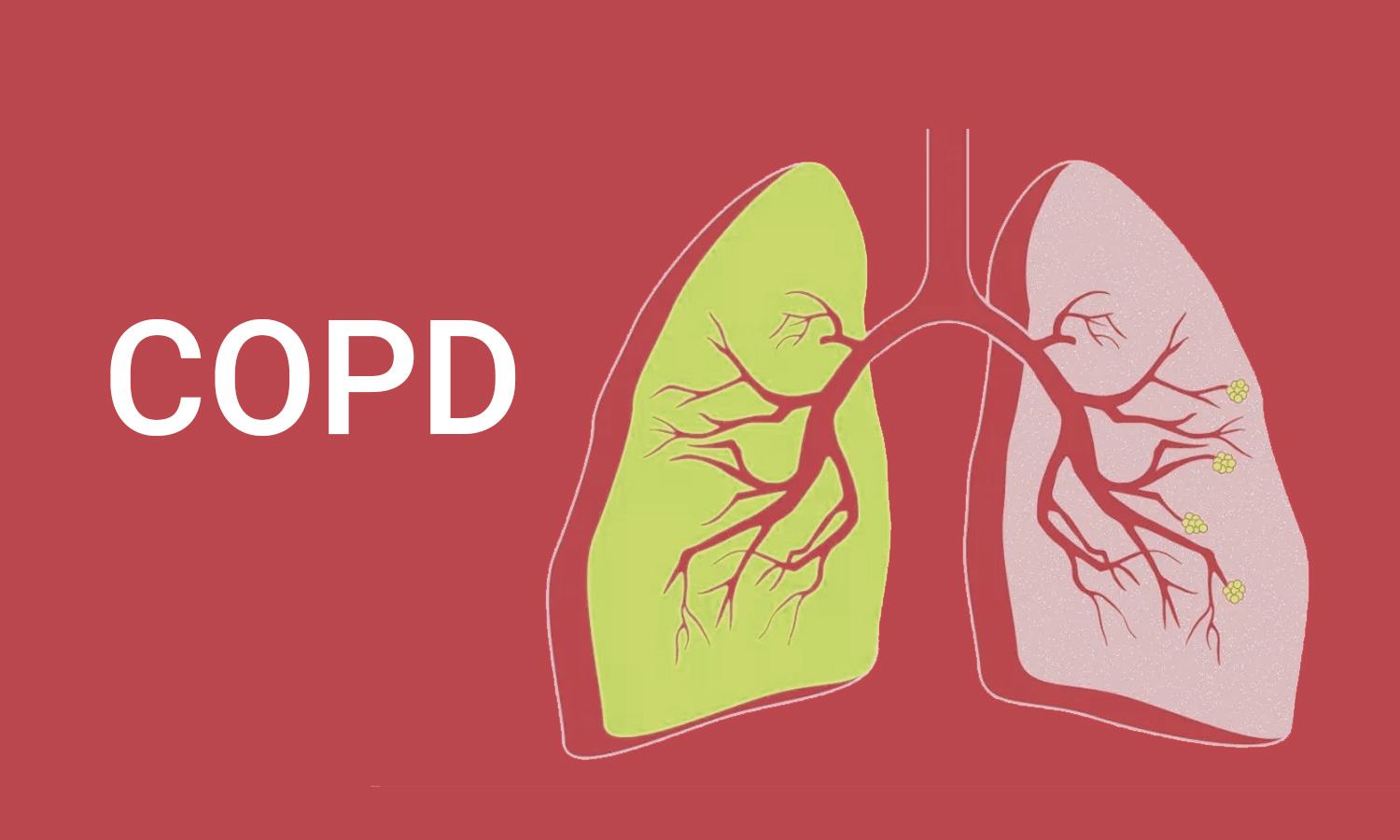 Guest Blog- Chronic Obstructive Pulmonary Disease