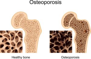 Osteoporosis-treatment