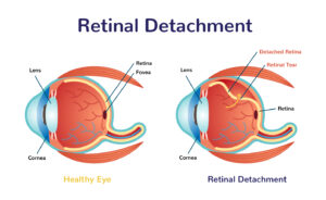 Retinal-Detachment-Surgery