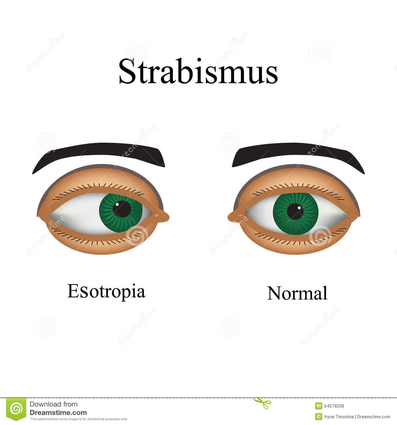 Guest Blog: Strabismus Surgery- Cure For Strabismus Disorder