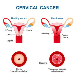 Cervical-Cancer-Treatment