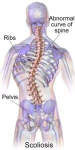 Scoliosis-Symptoms