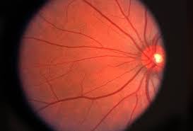 Guest Blog: Types And Symptoms Of Common Retinal Diseases