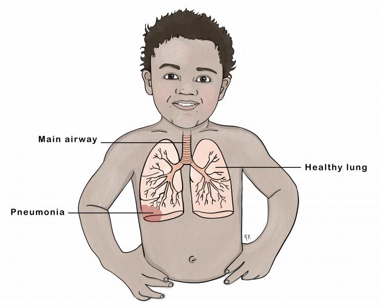 Foods-to-eat-during-Pneumonia