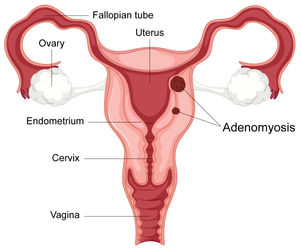 Adenomyosis-Treatment-In-South-India