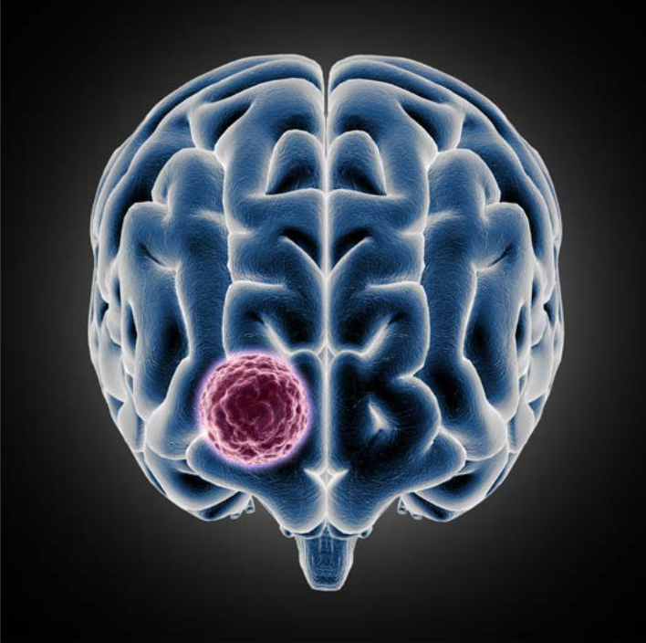 Brain-Tumour