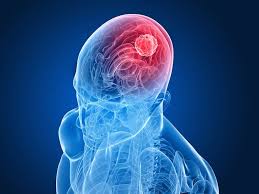 Know About Treatment, and Myth-Busting On Brain Tumours