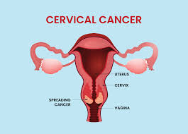 Cervical-Cancer-prevention