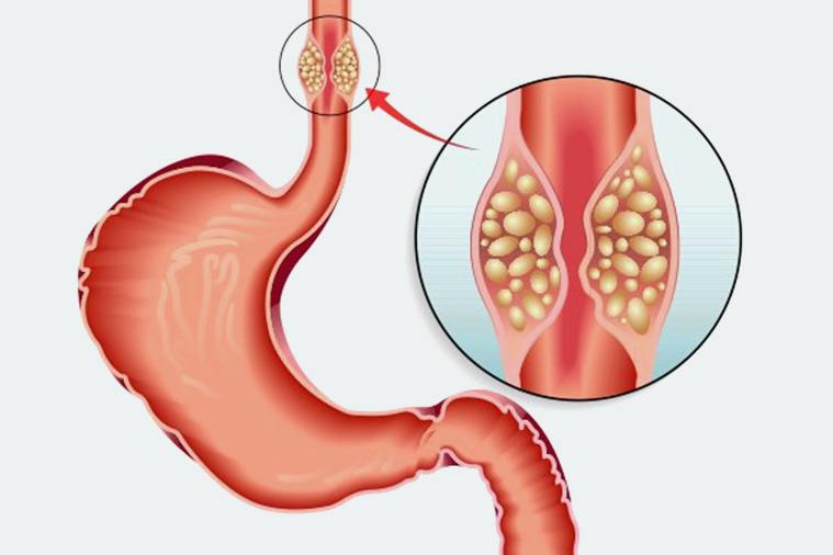 Know About The Important Signs Of Esophageal Cancer