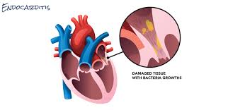 Infective-endocarditis Desun-Hospital