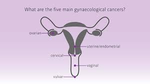 Gynecologic Cancers- A Great Health Concern For Indian Women
