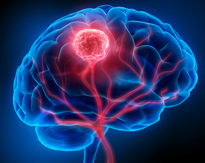 Patients Share Excellent Stories At World Brain Tumour Day Event