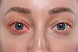 Conjunctivitis-Cases