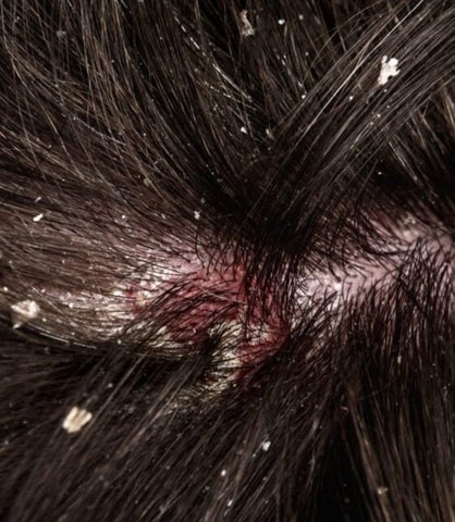 Dandruff