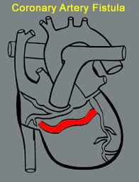 Successful Treatment Of A Rare Dual Coronary Artery Fistula