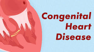 Heart-Disease
