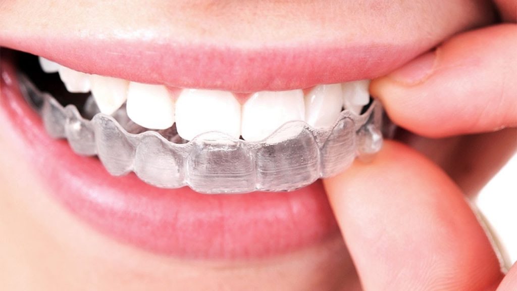Guest Blog: Upcoming Trend of Invisible Dental Braces in Kolkata