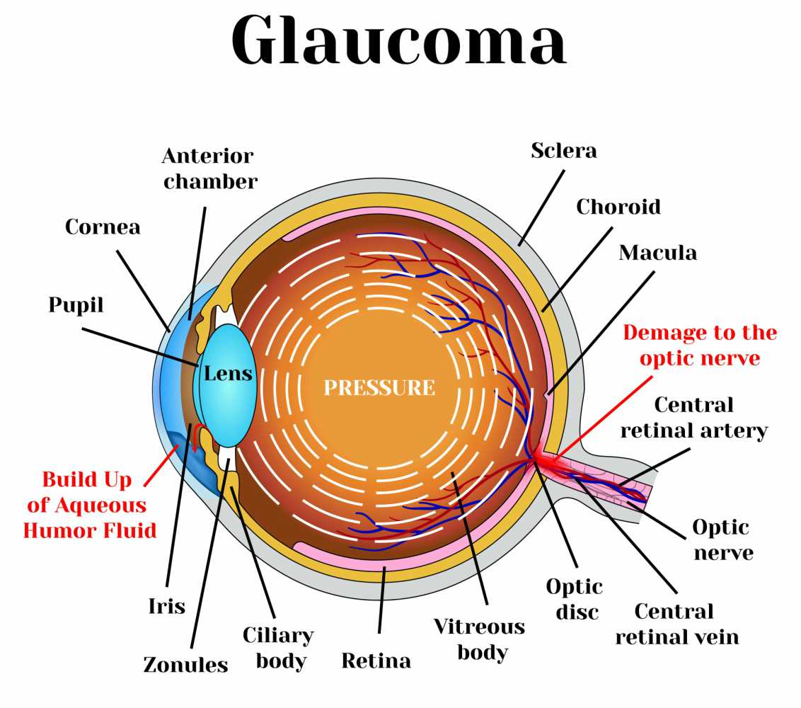 Guest Blog: Glaucoma-Myths and Facts