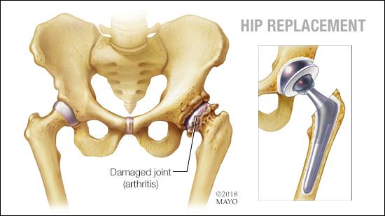 Guest Blog- New Hip Replacement Procedure Brings Full Mobility to Patients