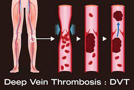 Guest Blog: Deep Vein Thrombosis- A Threat To Life