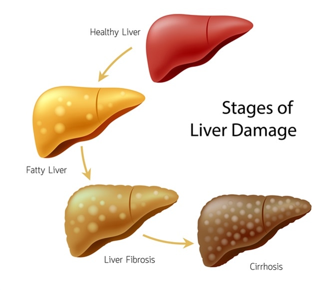 Guest Blog: Liver Cirrhosis- Early Detection May Help Patients