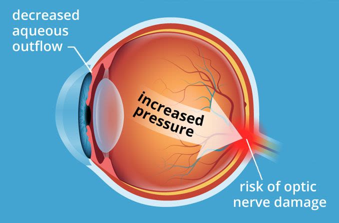 Guest Blog: What Happens When You Have High Eye Pressure?