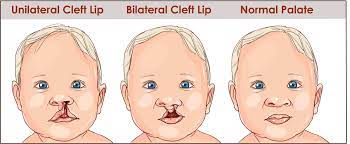 Mission Smile Offered Free Cleft Lip Corrective Surgeries To Children And Young Adults