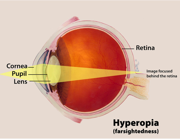 Guest Blog: What Is Hyperopia And Its Treatment?