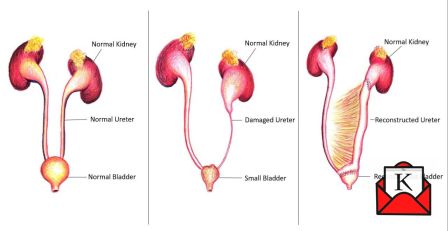 India’s 1st Laparoscopic Urinary Bladder And Ureter Reconstruction Conducted At Fortis Hospital, Kolkata