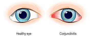 How To Protect Your Eyes From Conjunctivitis?