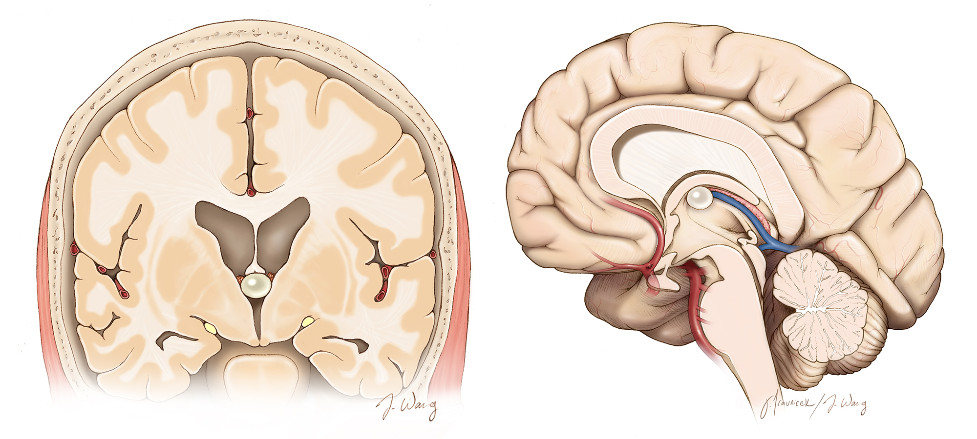 Colloid Cysts In The Brain: Symptoms, Diagnosis, & Treatment