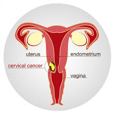 Prevent Cervical Cancer Easily With Early Screening & Vaccination