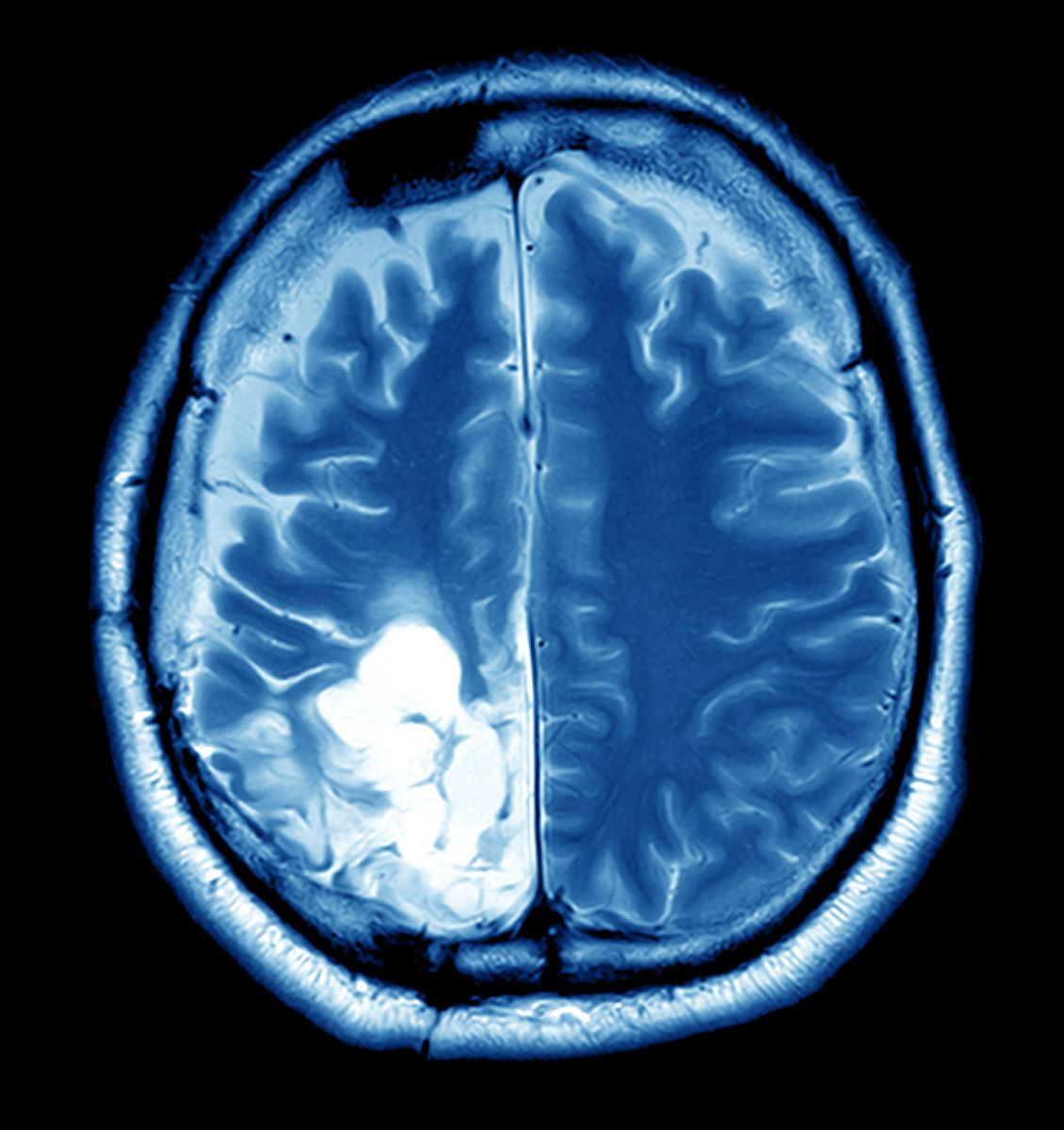 How To Spot A Brain Tumour Early?