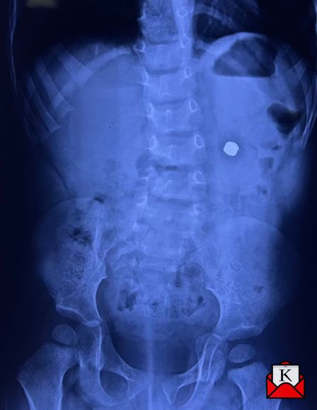 19-Month-Old Gets A New Lease Of Life At Manipal Hospital