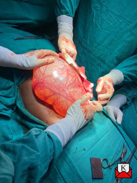 Successful Removal Of 3.8 KG Ovarian Cyst At NIIMS Hospital
