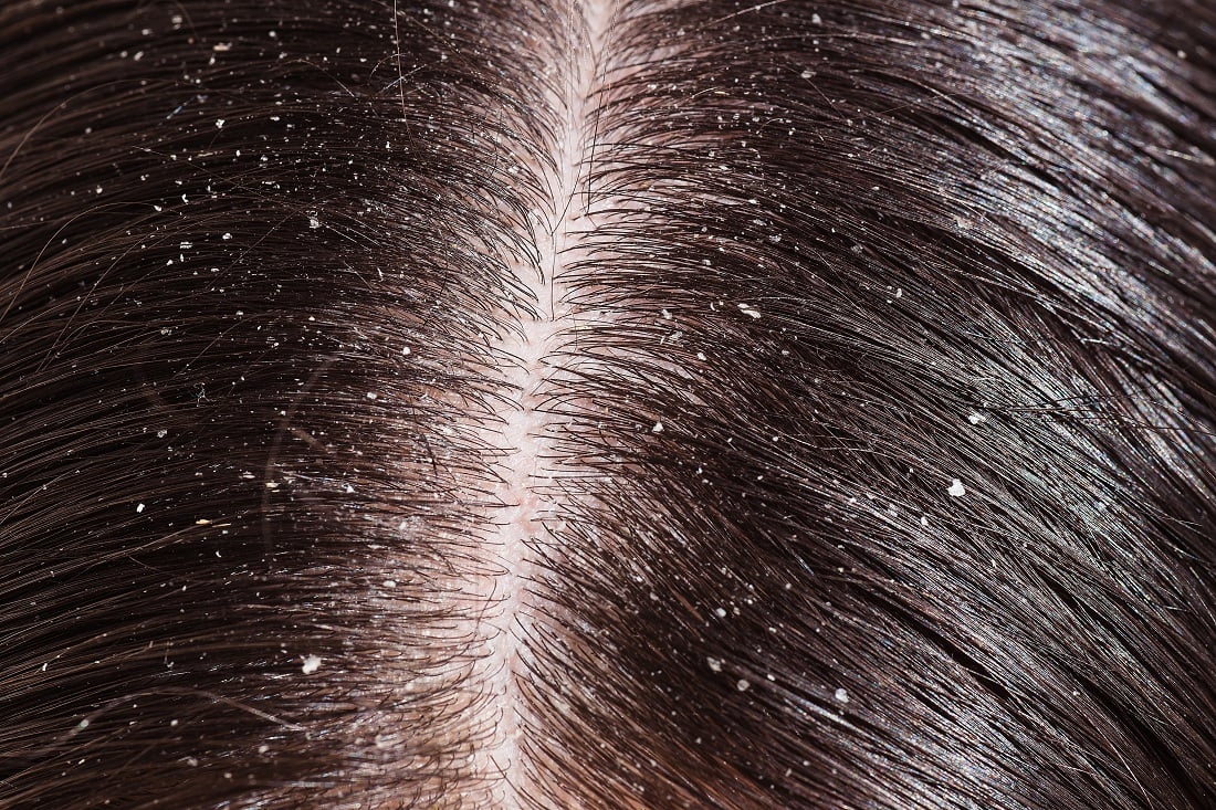 Dandruff & Scalp Health: Know The Great Link Between Them
